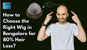 Hair Patch Fixing in Bangalore